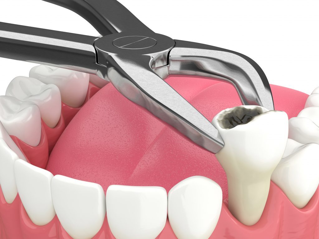 Dental Extraction
